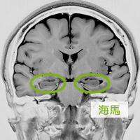 VSRAD(MRI脳萎縮度検査) VSRAD(MRI脳萎縮度検査)